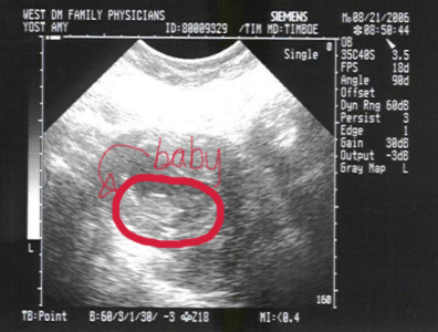 First Ultrasound - 11 weeks